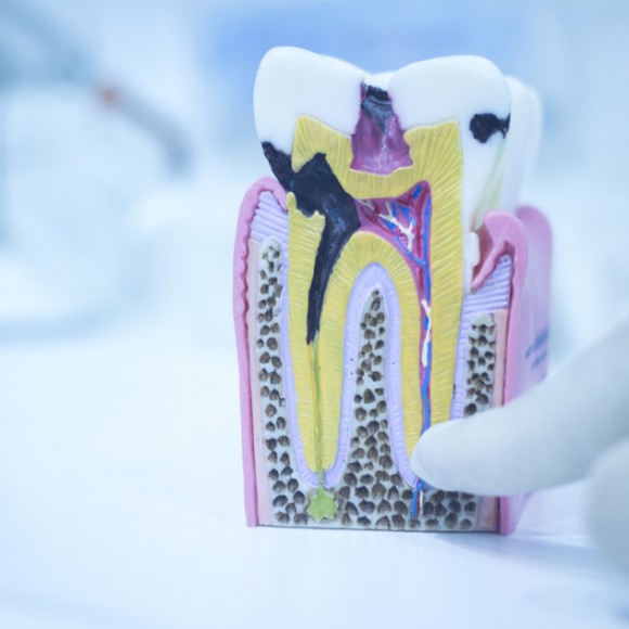 Lečenje kanala korena – endodontska terapija
