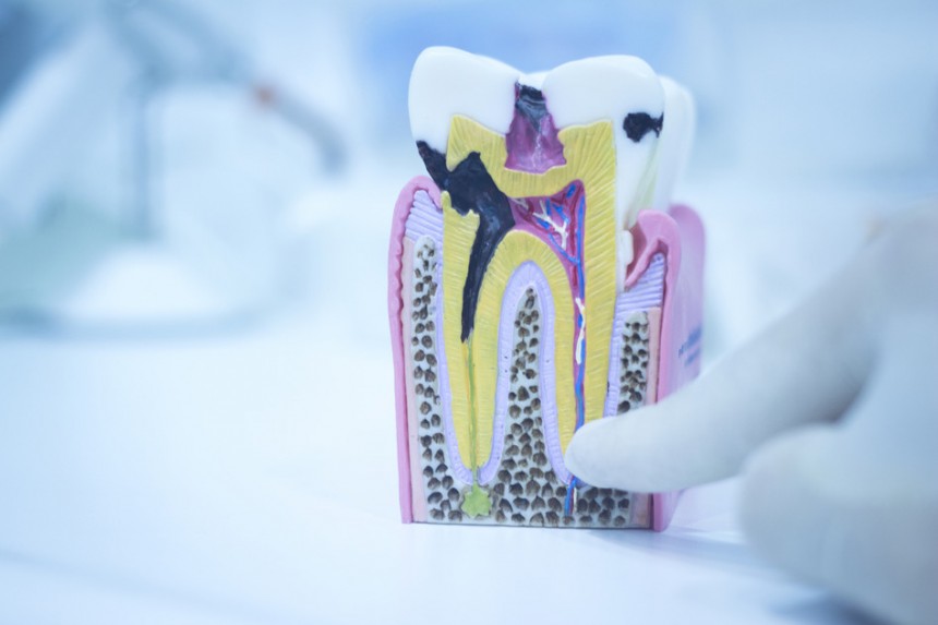 Lečenje kanala korena – endodontska terapija