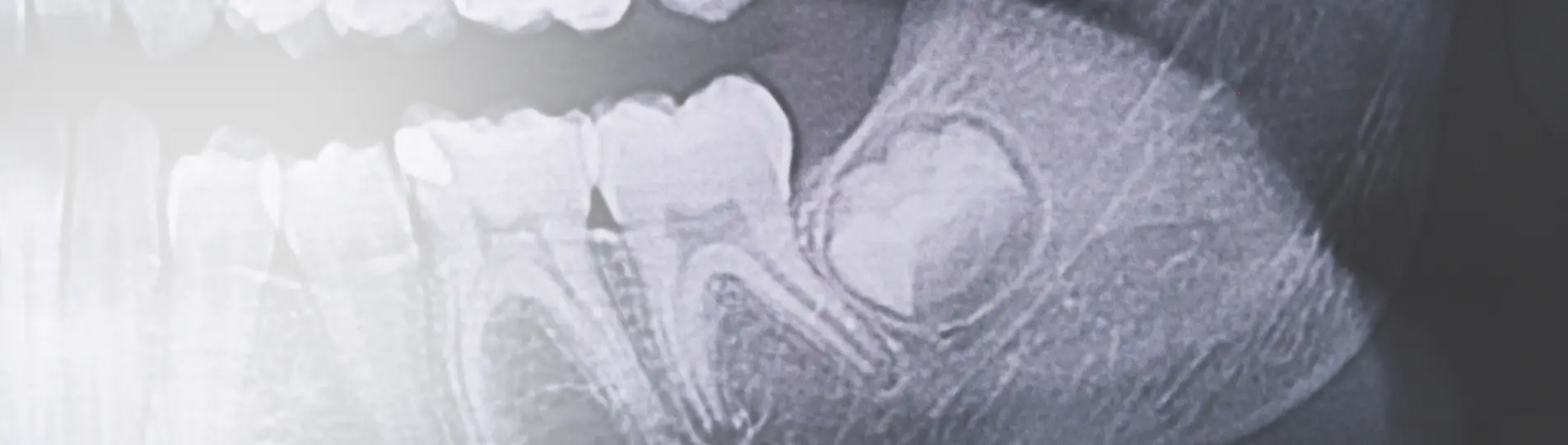X-ray image of the lower jaw showing a wisdom tooth growing at an improper angle.