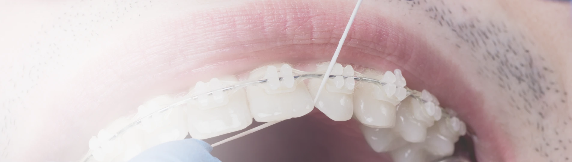 Using dental floss on teeth with fixed orthodontic braces.