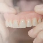 Partial Edentulism and Types of Prosthetic Restorations