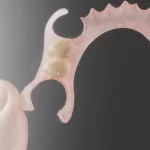Partial Acrylic Dentures