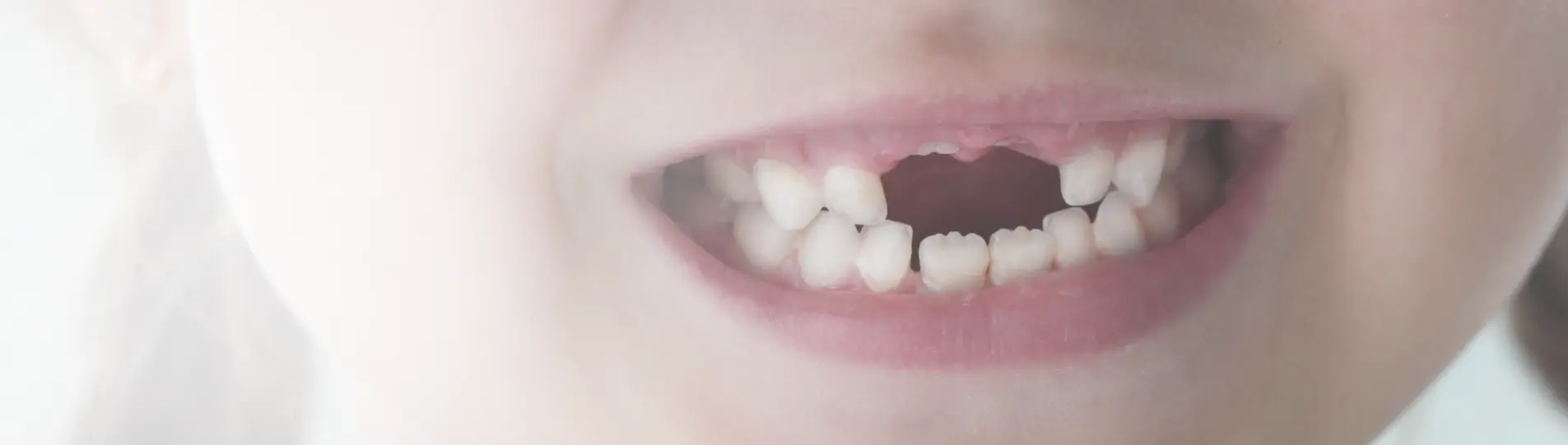 Child’s smile showing gaps from lost baby teeth and newly erupting permanent teeth.