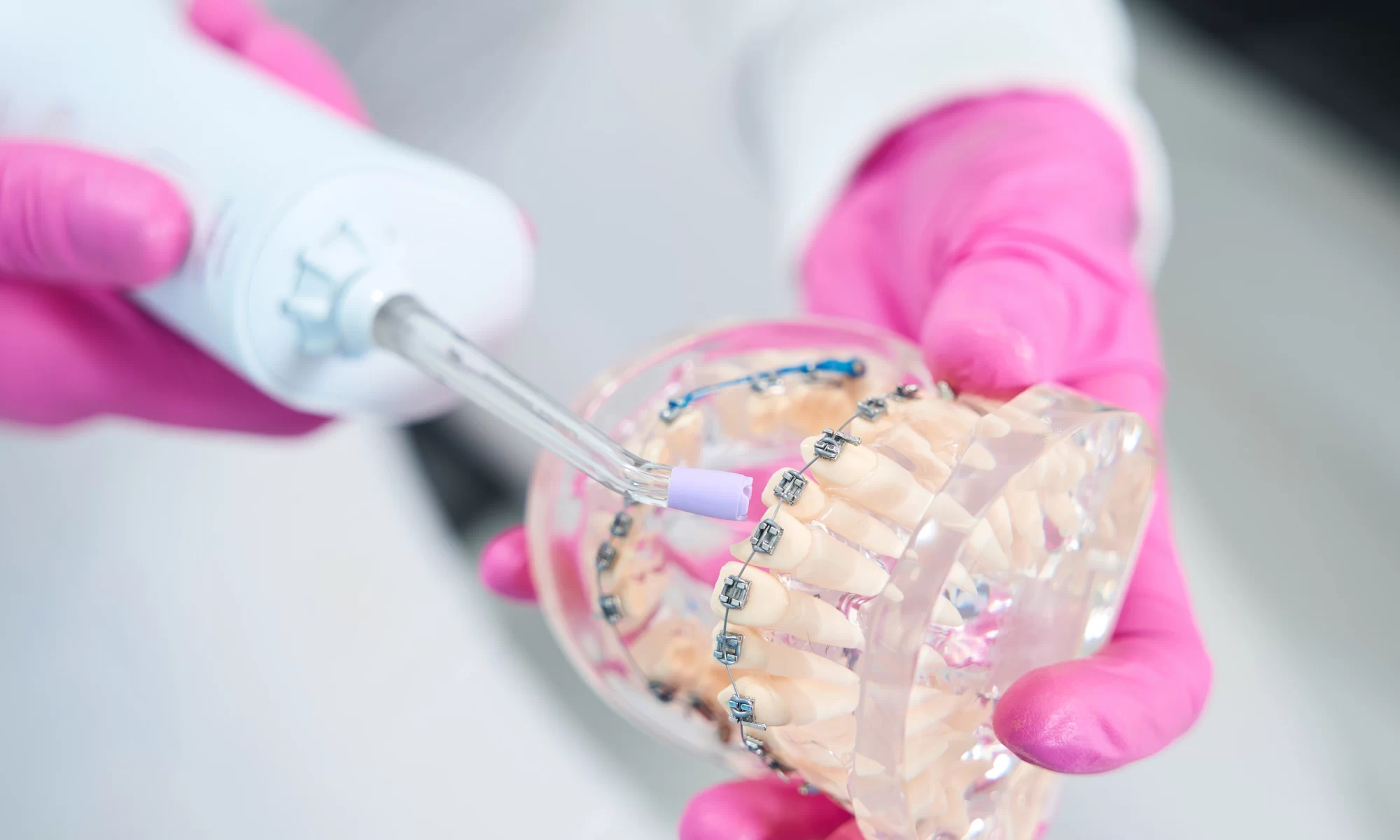 Stomatolog u ružičastim rukavicama demonstrira ortodontski model sa fiksnom protezom i dentalnim instrumentom