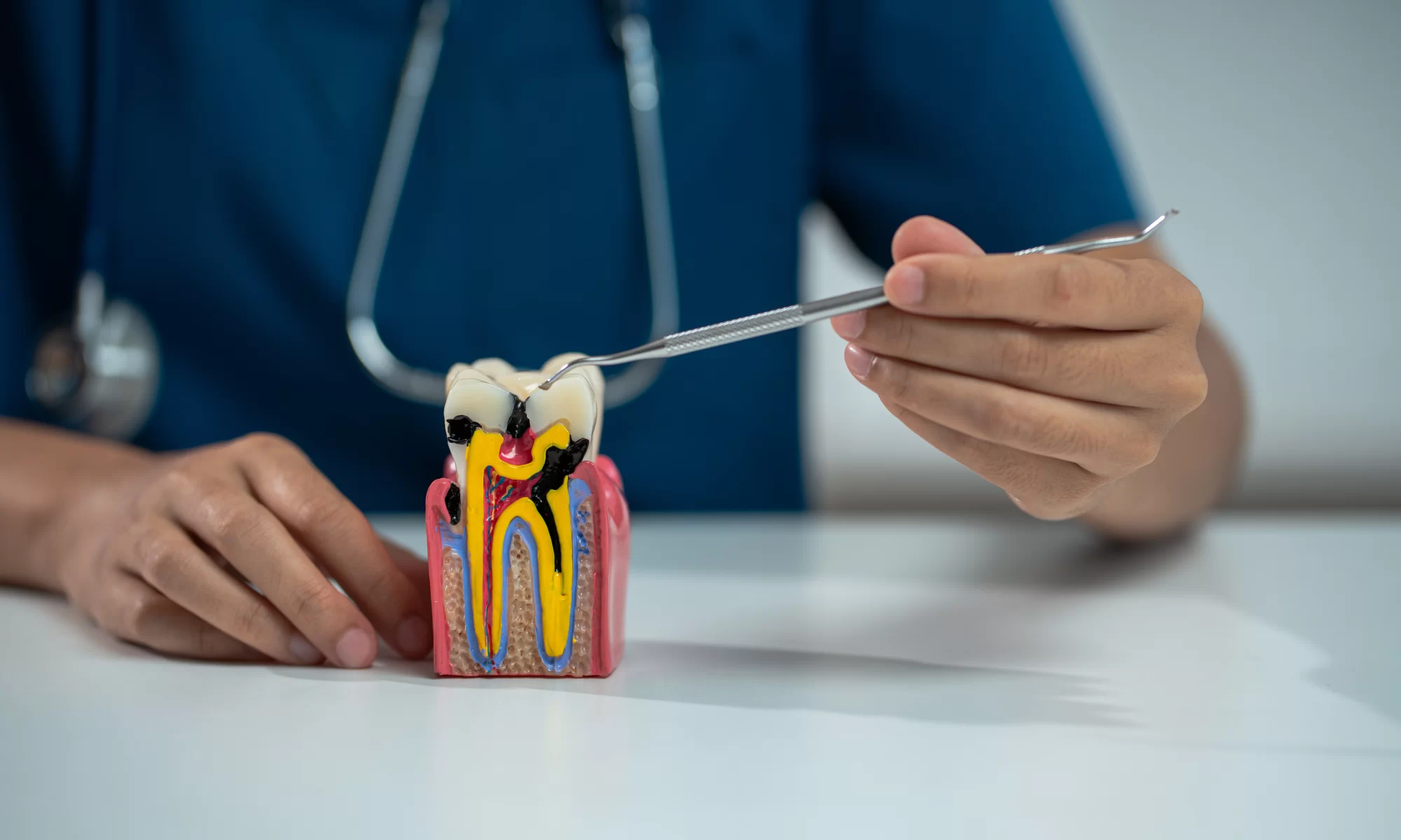 Stomatolog pokazuje model zuba sa prikazanim karijesom i kanalskim sistemom koristeći dentalni instrument