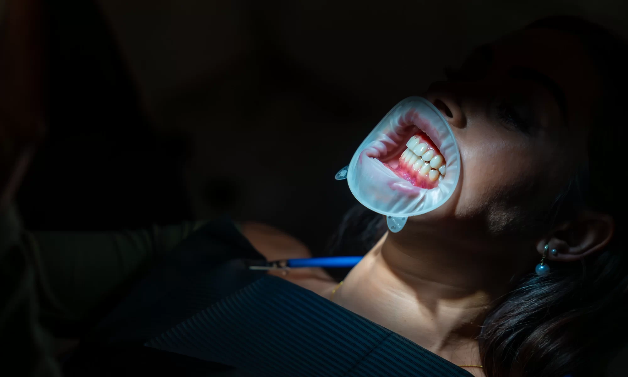 Pacijentkinja tokom stomatološkog tretmana sa retraktorom usana koji otkriva zube pod jakim svjetlom