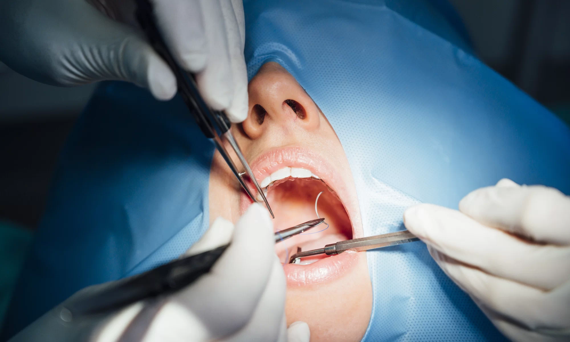 Oralni hirurški zahvat u toku, sa stomatološkim instrumentima i zaštitnom folijom oko pacijentovih usta