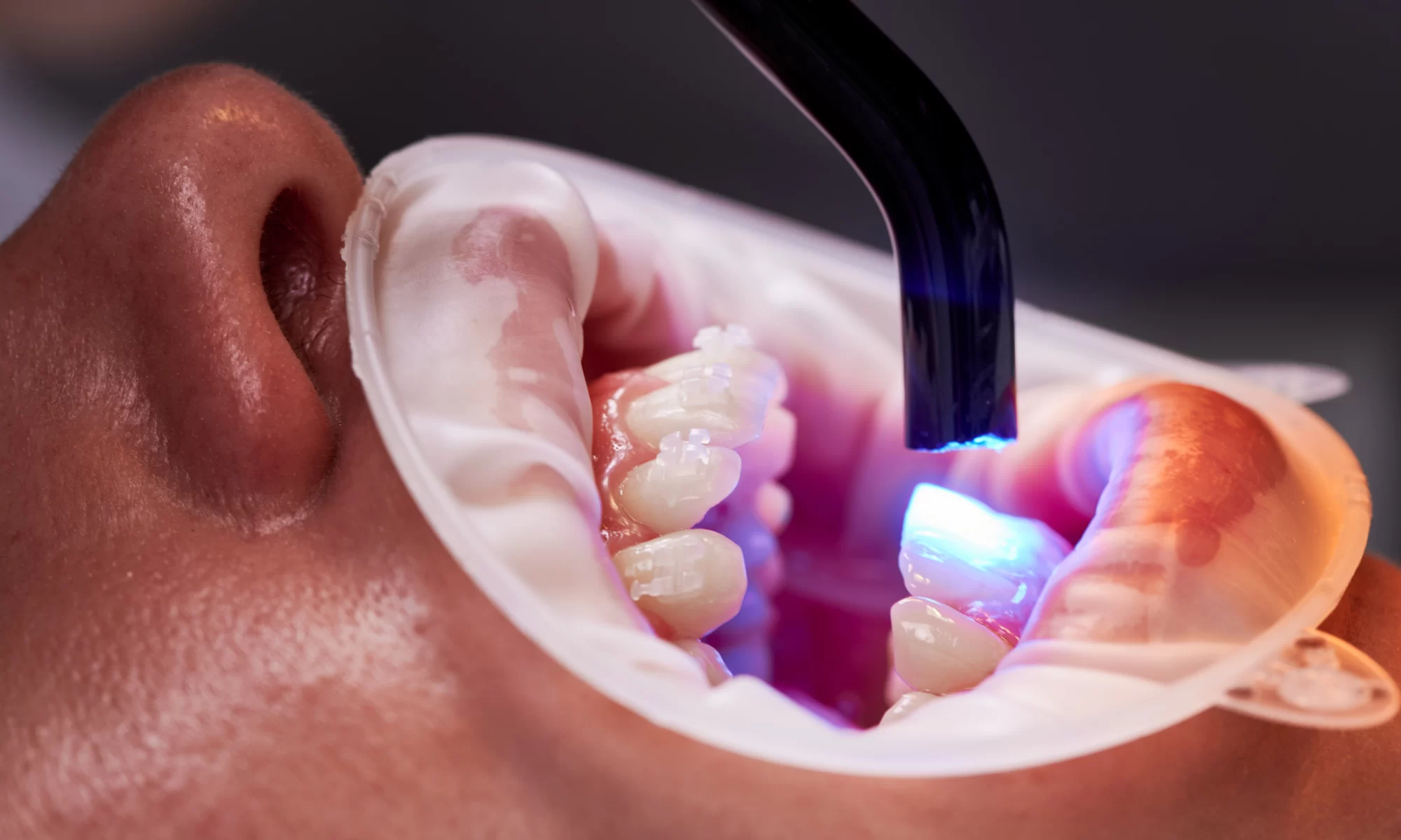 Stomatološki tretman tokom kog se zubi osvjetljavaju plavim LED ili laserskim svjetlom uz postavljen retraktor